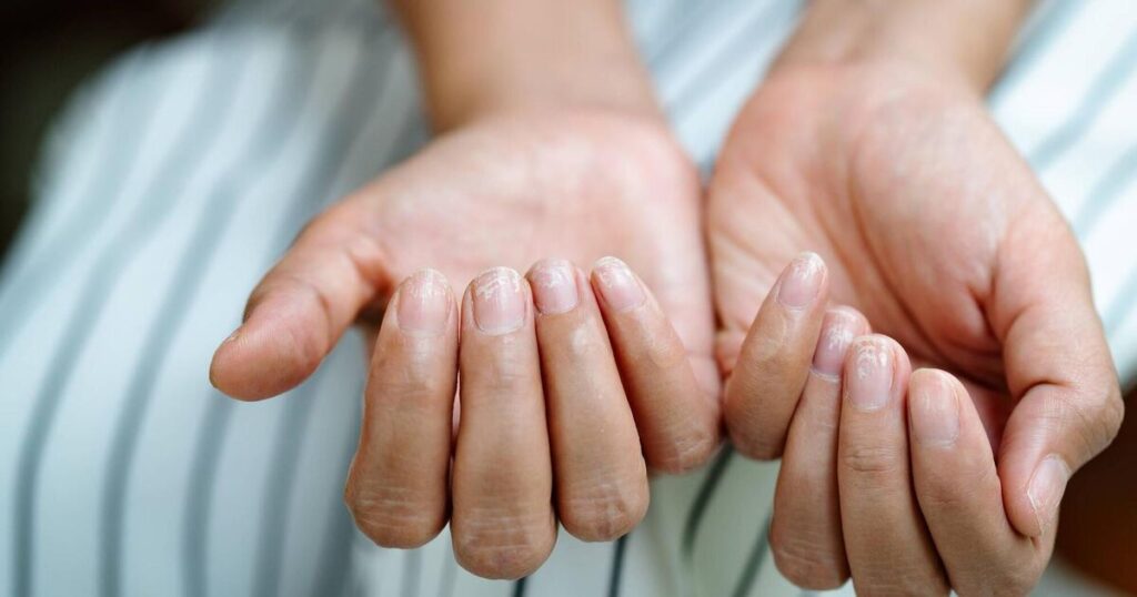 My nails keep breaking even though I have plenty of calcium in my diet